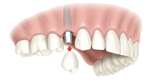 Single Dental Implants Fresno