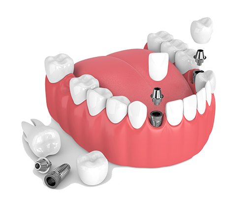 Multiple Teeth Dental Implants in Fresno